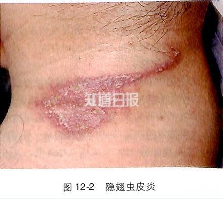 得了隐翅虫皮炎该怎么办?