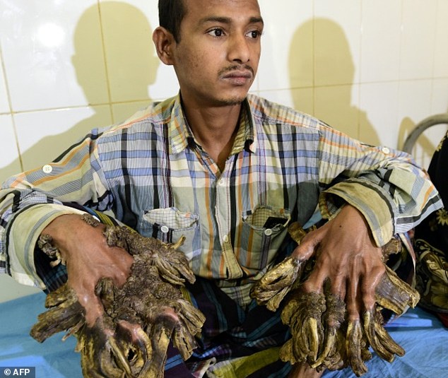 孟加拉"树人"手术切除肉疣 渴望过正常人的生活
