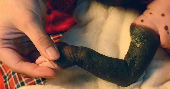 河北女婴患罕见"巨型兽皮痣" 整只手臂被黑色斑块覆盖