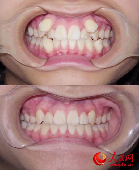 虎牙突出于牙弓之外,与对颌牙齿不能正常咬合,无法发挥尖牙应有的撕咬