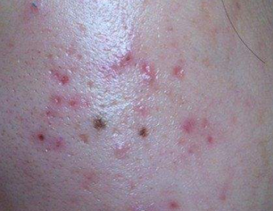 在面部就会生成红斑,丘疹及脓包等症状,这个时候很有可能是螨虫作怪